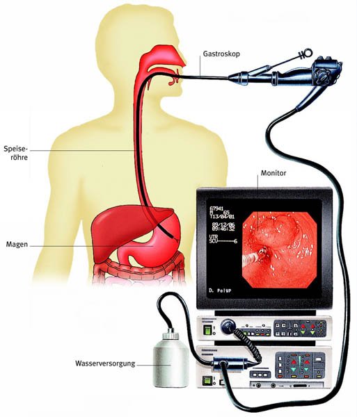 hastroscopiya