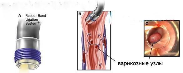 ligation